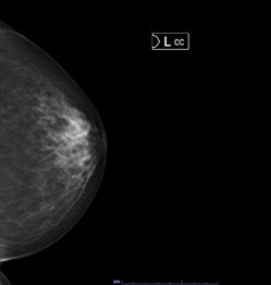 左の乳腺の上下方向のX線画像