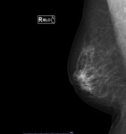 右の乳腺の斜め方向のX線画像