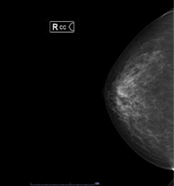 右の乳腺の上下方向のX線画像