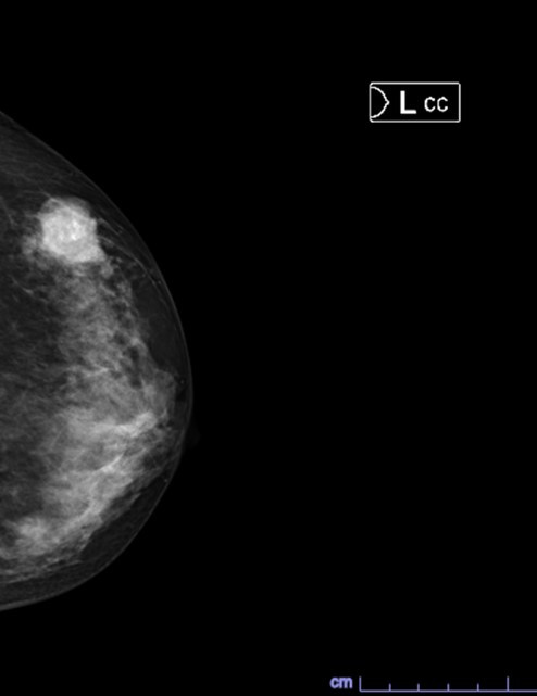 左の乳腺の水平方向の病変X線画像