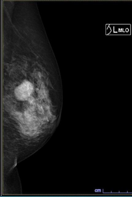 左の乳腺の斜め方向の病変X線画像