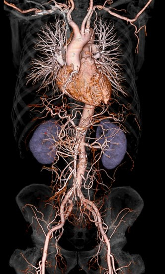 胸腹部血管の環状断のCT画像