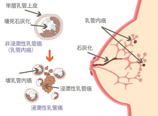 乳がんのイメージ図
