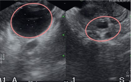 単胞性卵巣嚢腫の超音波画像