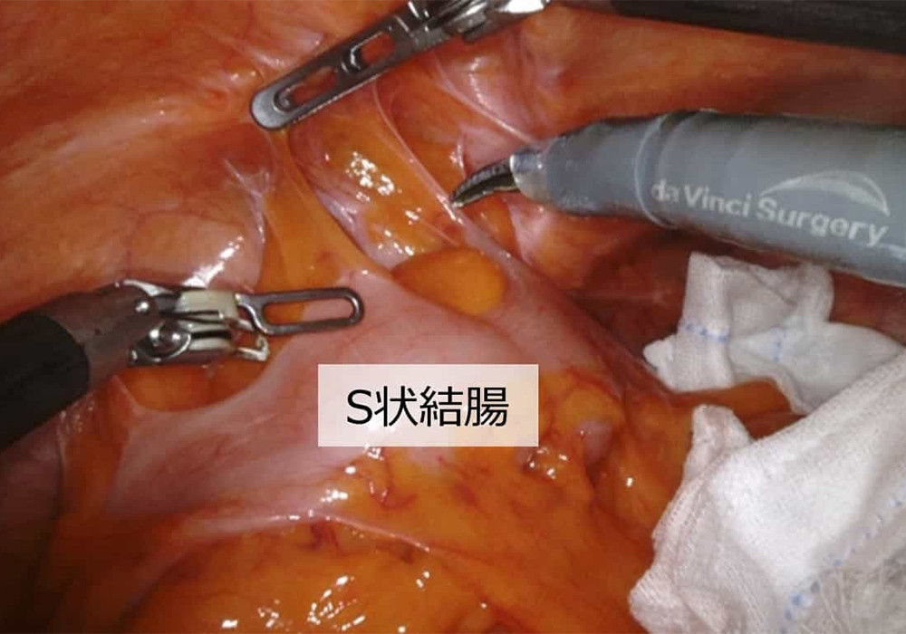 写真：ロボット支援結腸手術の一場面3