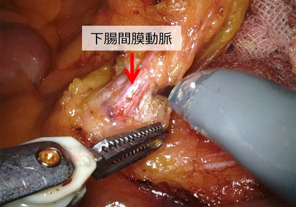 写真：ロボット支援結腸手術の一場面5
