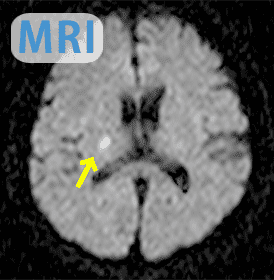 写真：MRIの出力画像