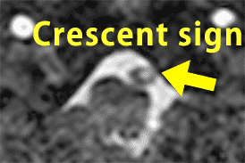 MRA図。Crescent sign箇所のアップ。