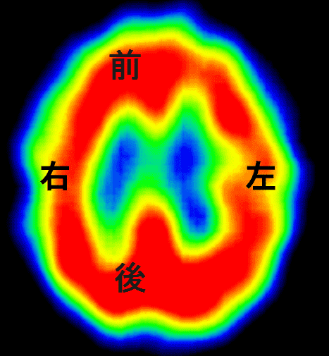 脳血流SPECT−１