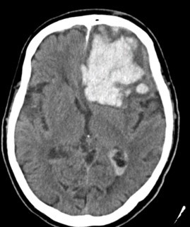 脳挫傷の手術前CT画像