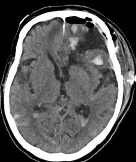 脳挫傷の手術後CT画像