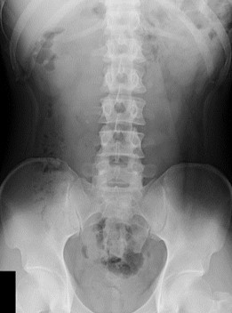 検査前の単純腹部のX線画像